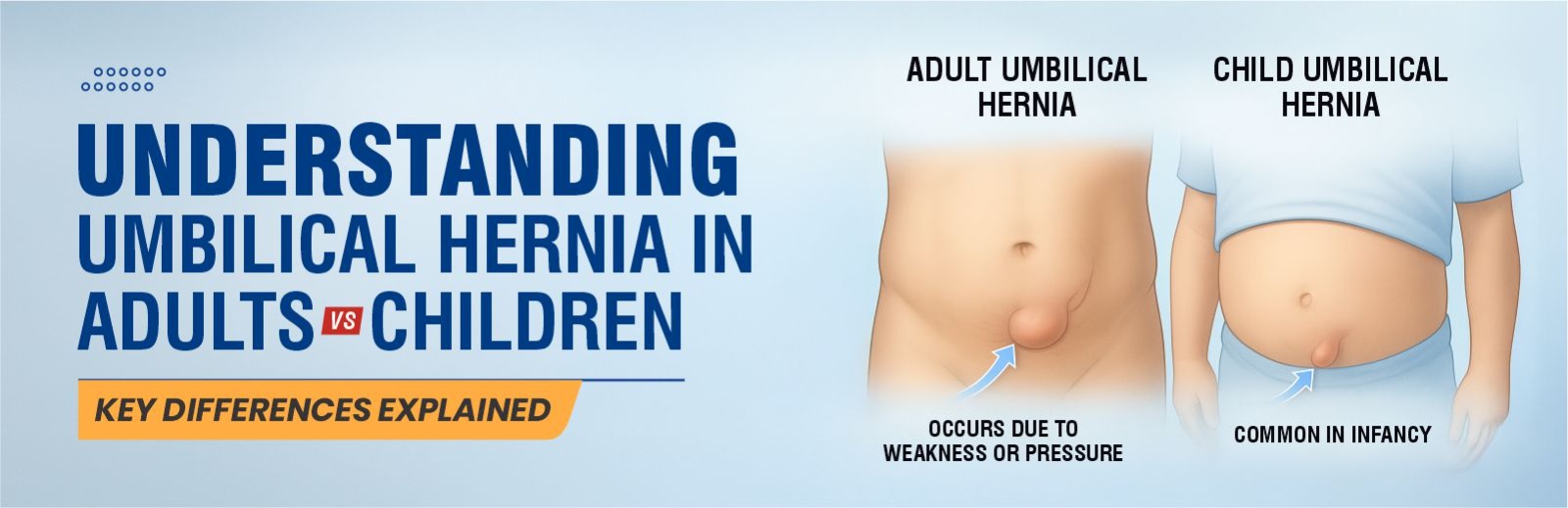 Umbilical Hernia