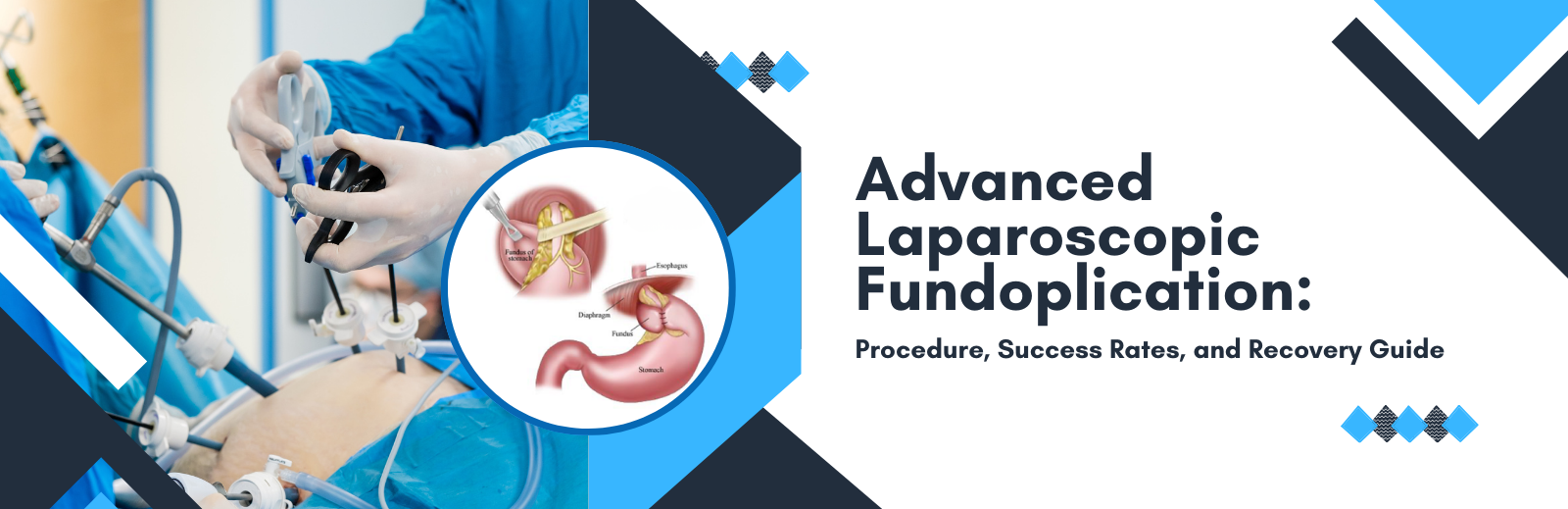 Advanced Laparoscopic Fundoplication